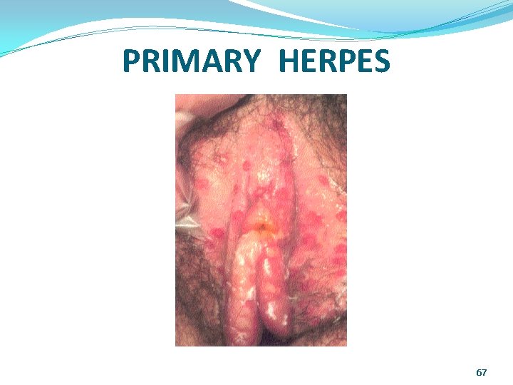 PRIMARY HERPES 67 