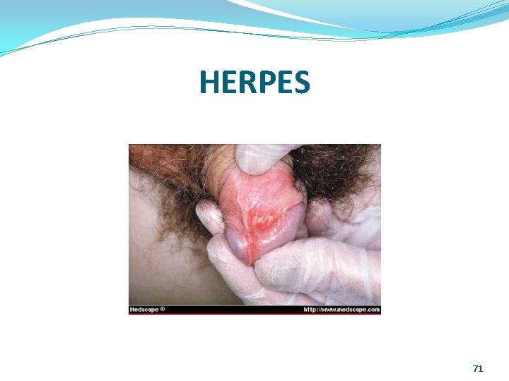 HERPES 71 