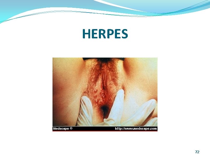 HERPES 72 