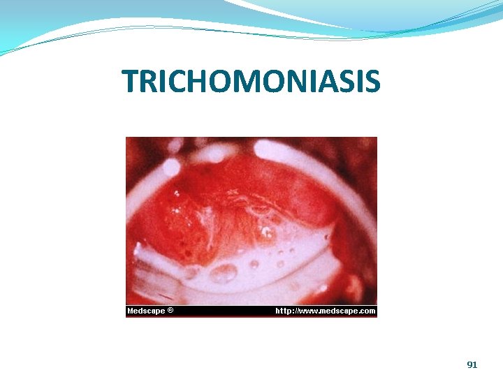TRICHOMONIASIS 91 