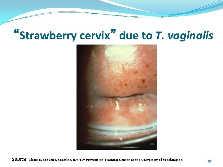 “Strawberry cervix” due to T. vaginalis Source: Claire E. Stevens/Seattle STD/HIV Prevention Training Center