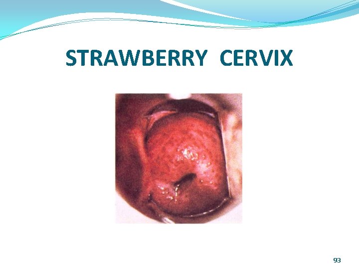 STRAWBERRY CERVIX 93 