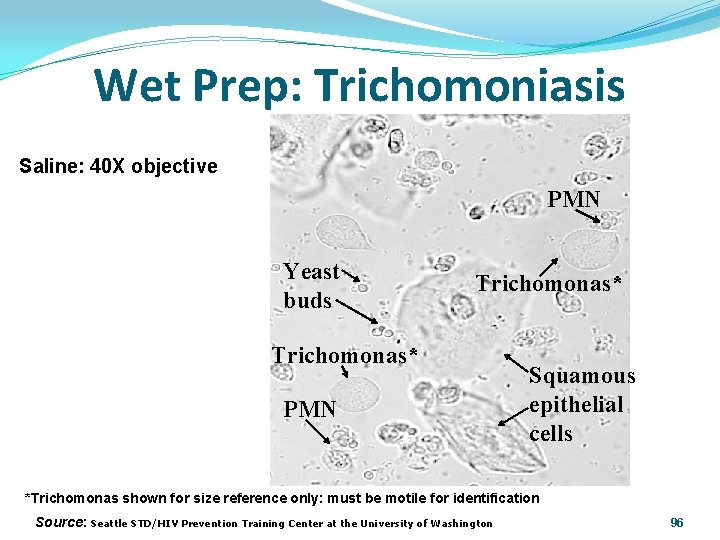 Wet Prep: Trichomoniasis Saline: 40 X objective PMN Yeast buds Trichomonas* PMN Squamous epithelial