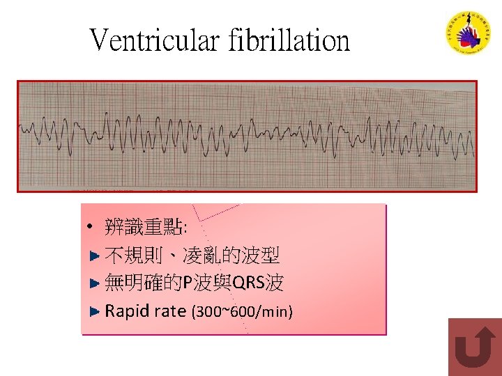 Ventricular fibrillation • 辨識重點: 不規則、凌亂的波型 無明確的P波與QRS波 Rapid rate (300~600/min) 