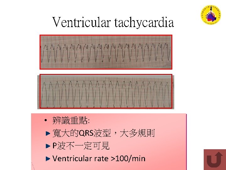 Ventricular tachycardia • 辨識重點: 寬大的QRS波型，大多規則 P波不一定可見 Ventricular rate >100/min 