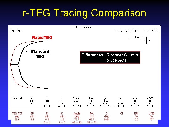 r-TEG Tracing Comparison Rapid. TEG Standard TEG Differences: R range: 0 -1 min &