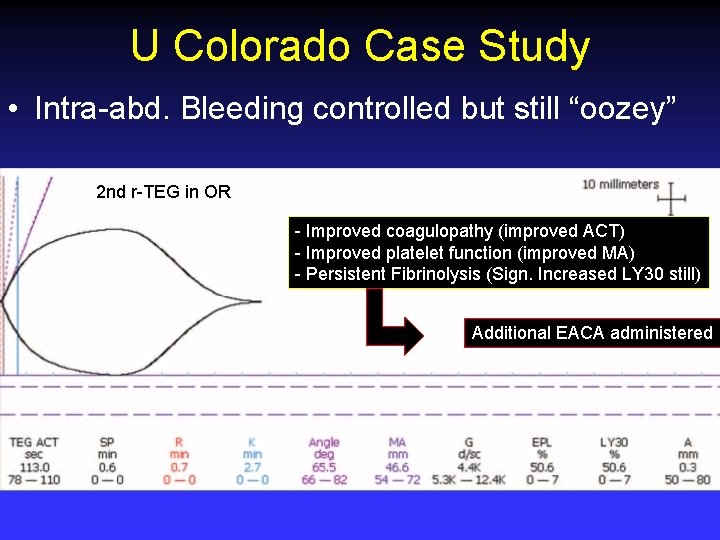 U Colorado Case Study • Intra-abd. Bleeding controlled but still “oozey” 2 nd r-TEG