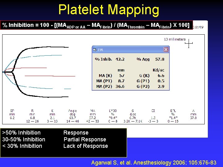 Platelet Mapping % Inhibition = 100 - [(MAADP or AA – MAFibrin) / (MAThrombin