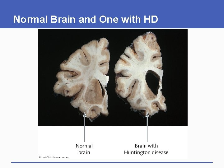 Normal Brain and One with HD 