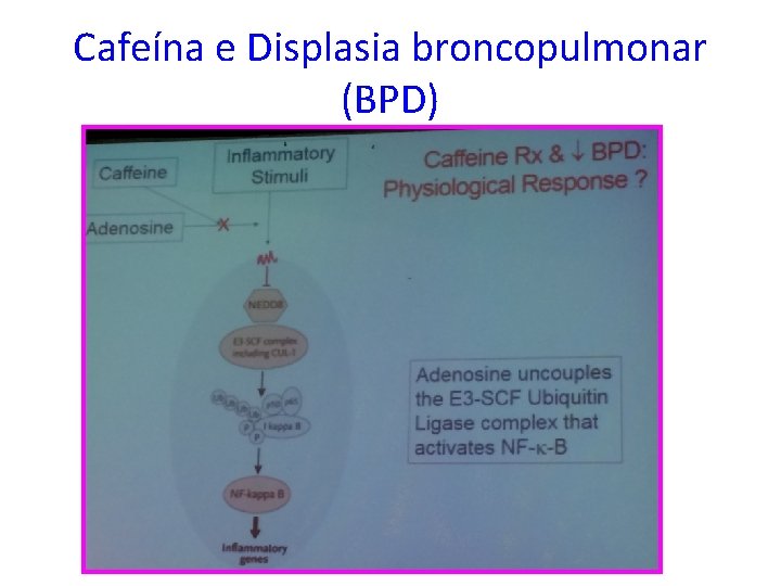 Cafeína e Displasia broncopulmonar (BPD) 