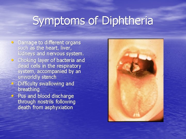 Symptoms of Diphtheria • Damage to different organs • • • such as the