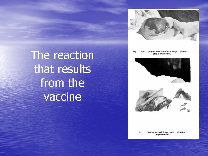 The reaction that results from the vaccine 