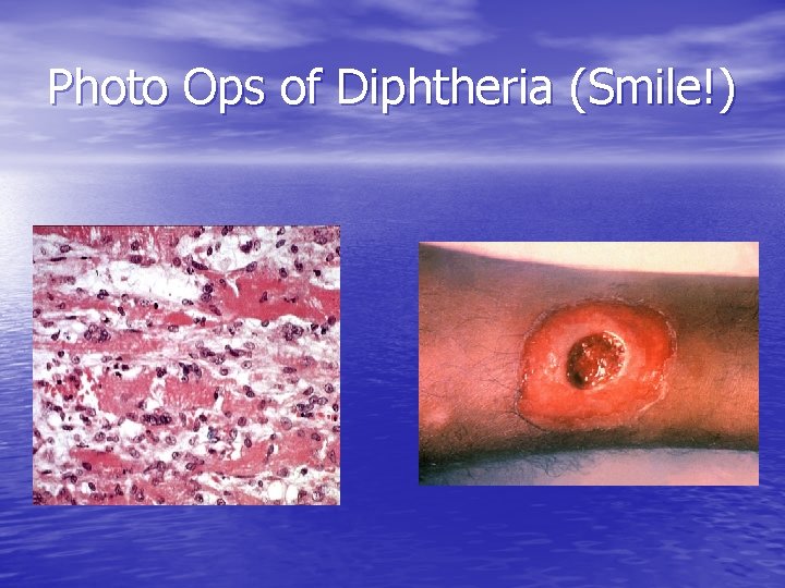 Photo Ops of Diphtheria (Smile!) 