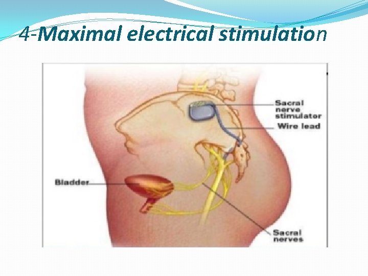 4 -Maximal electrical stimulation 