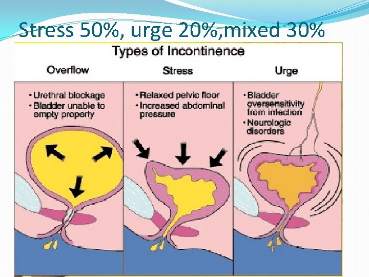 Stress 50%, urge 20%, mixed 30% 