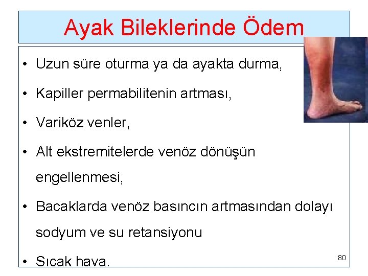 Ayak Bileklerinde Ödem • Uzun süre oturma ya da ayakta durma, • Kapiller permabilitenin