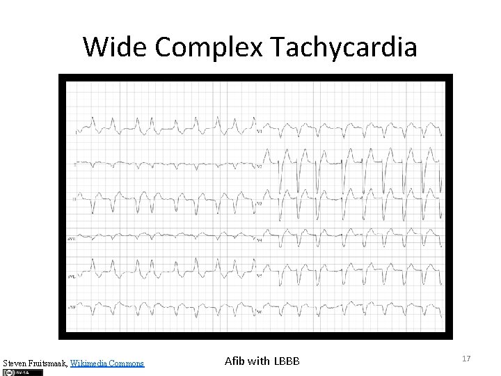 Wide Complex Tachycardia Steven Fruitsmaak, Wikimedia Commons Afib with LBBB 17 