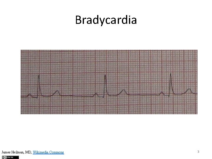 Bradycardia James Heilman, MD, Wikimedia Commons 3 