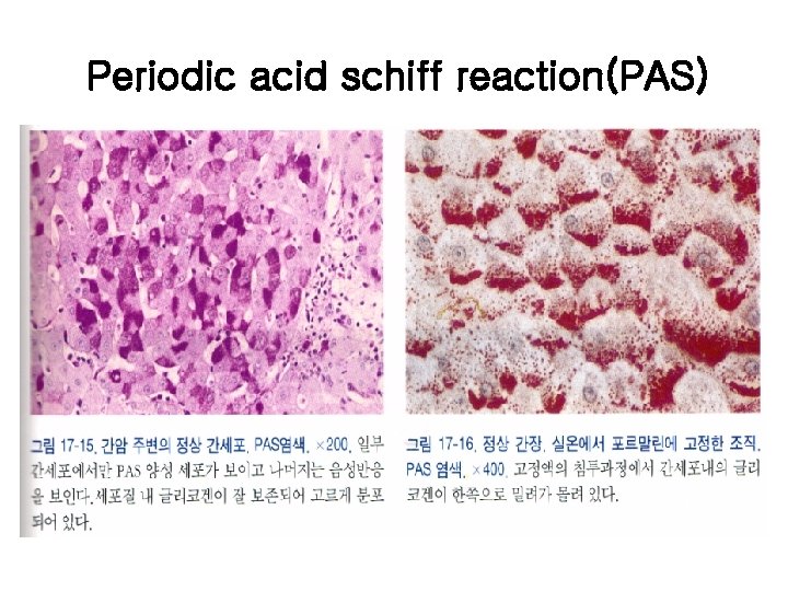 Periodic acid schiff reaction(PAS) 