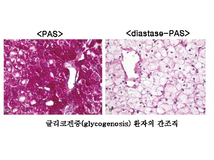<PAS> <diastase-PAS> 글리코겐증(glycogenosis) 환자의 간조직 