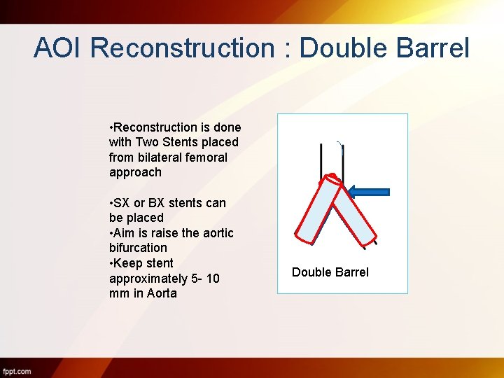 AOI Reconstruction : Double Barrel • Reconstruction is done with Two Stents placed from