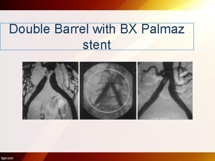 Double Barrel with BX Palmaz stent 