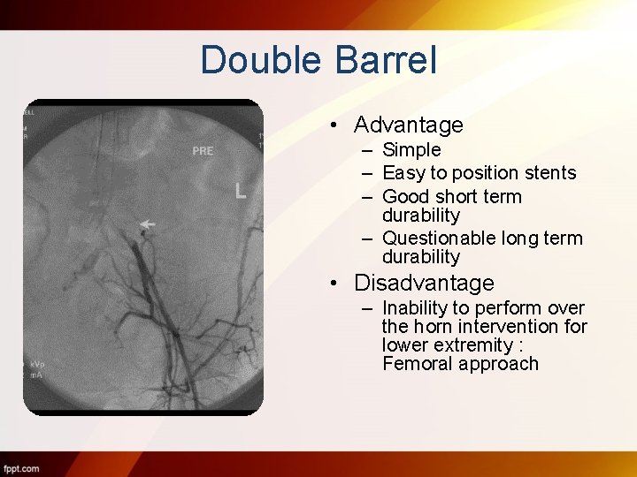 Double Barrel • Advantage – Simple – Easy to position stents – Good short