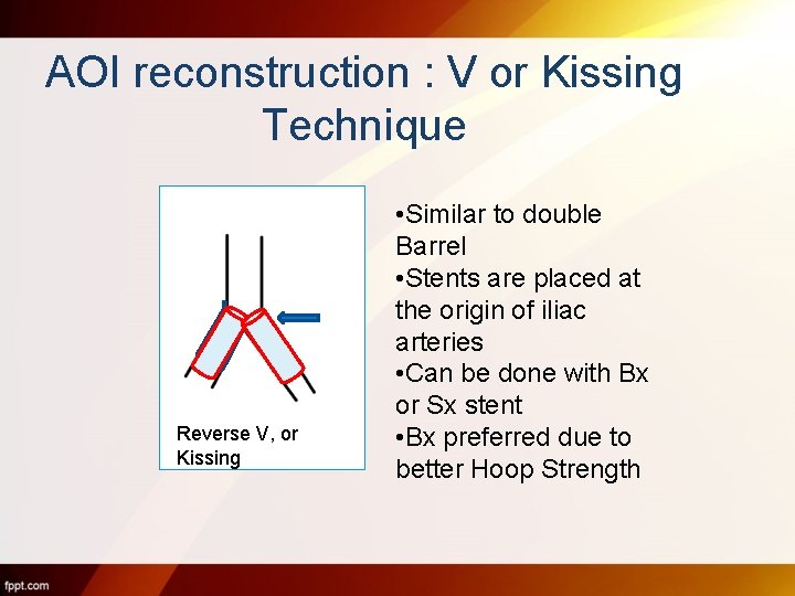 AOI reconstruction : V or Kissing Technique Reverse V, or Kissing • Similar to