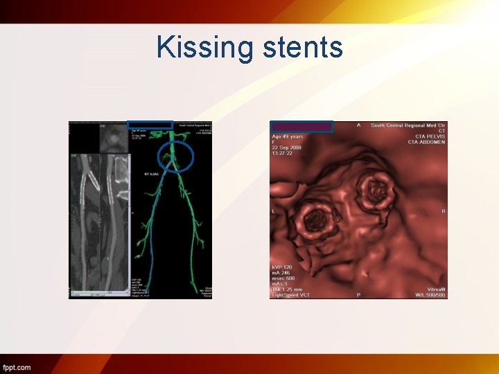 Kissing stents 