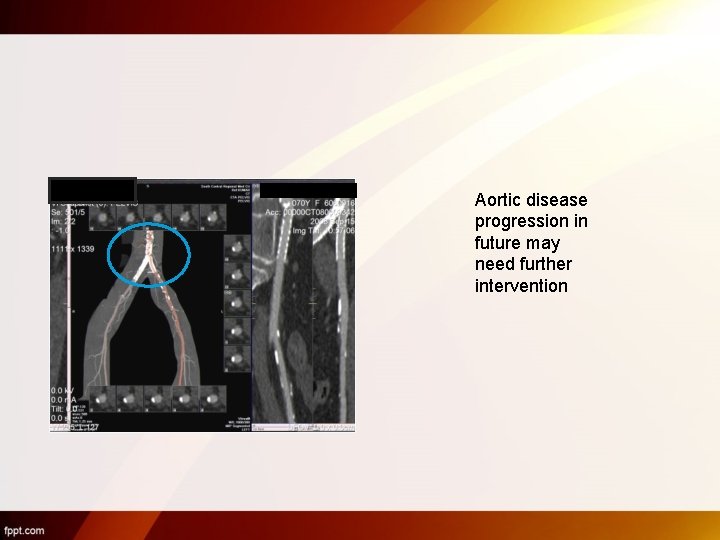 Aortic disease progression in future may need further intervention 