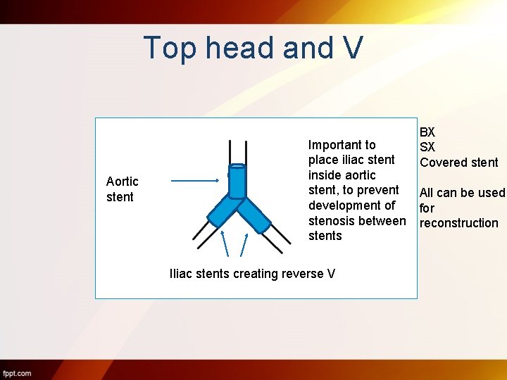 Top head and V Aortic stent Important to place iliac stent inside aortic stent,