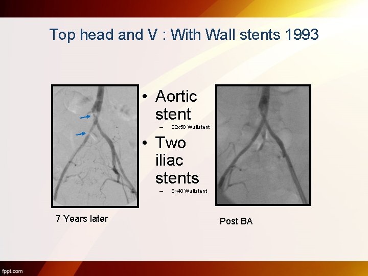 Top head and V : With Wall stents 1993 • Aortic stent – 20