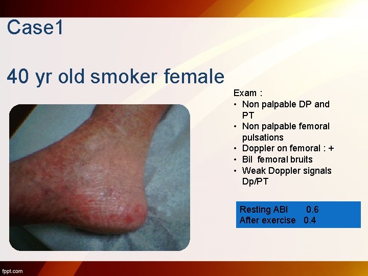 Case 1 40 yr old smoker female Exam : • Non palpable DP and