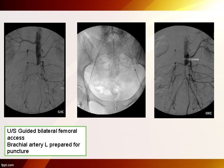 U/S Guided bilateral femoral access Brachial artery L prepared for puncture 