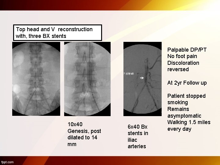 Top head and V reconstruction with, three BX stents Palpable DP/PT No foot pain