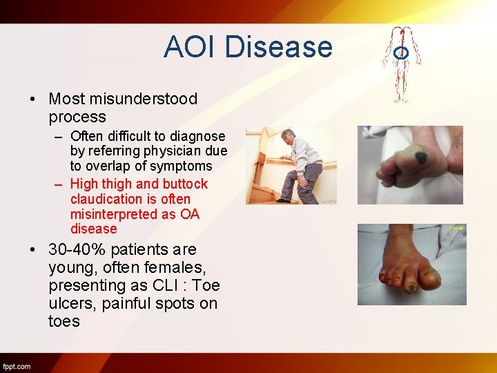 AOI Disease • Most misunderstood process – Often difficult to diagnose by referring physician