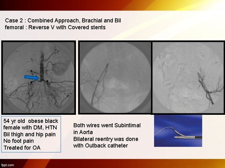 Case 2 : Combined Approach, Brachial and Bil femoral : Reverse V with Covered