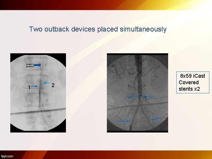 Two outback devices placed simultaneously Looped glidewire 1 2 8 x 59 i. Cast