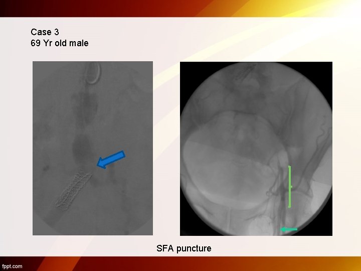 Case 3 69 Yr old male SFA puncture 