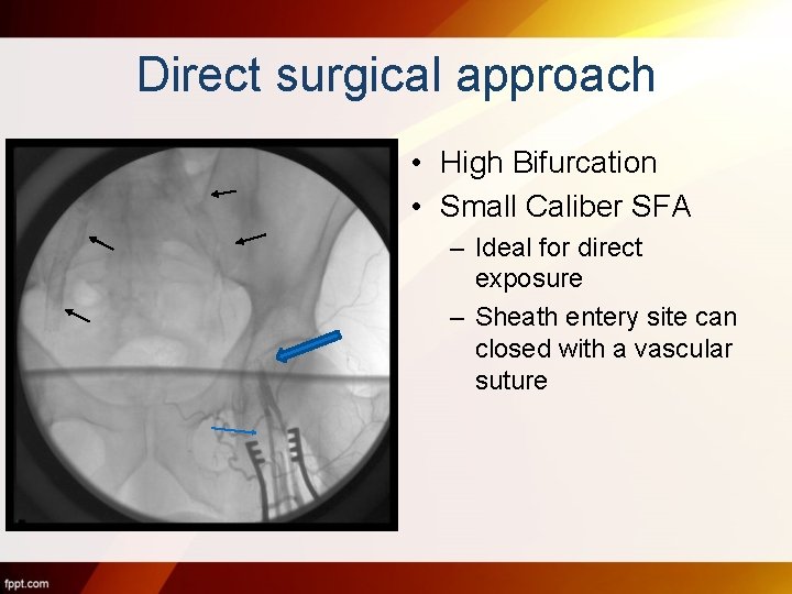 Direct surgical approach • High Bifurcation • Small Caliber SFA – Ideal for direct