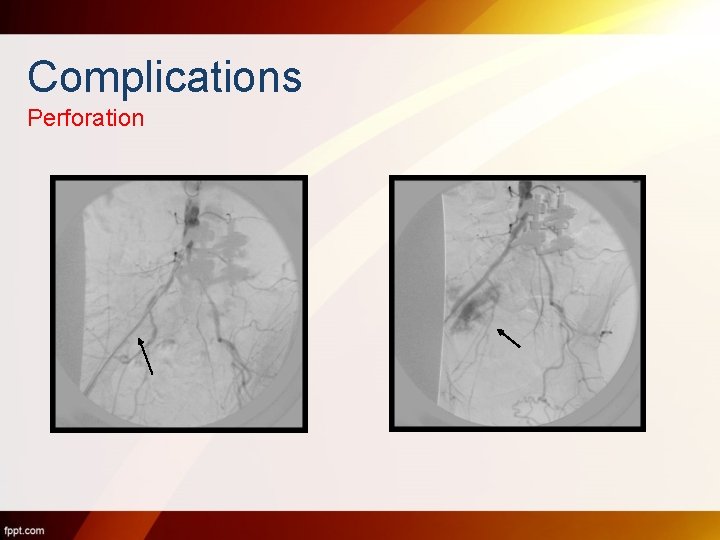 Complications Perforation 