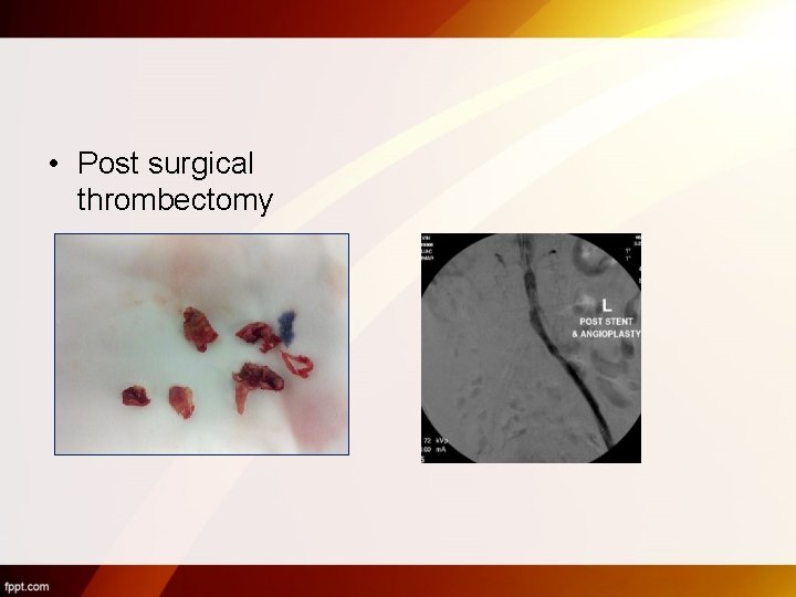  • Post surgical thrombectomy 