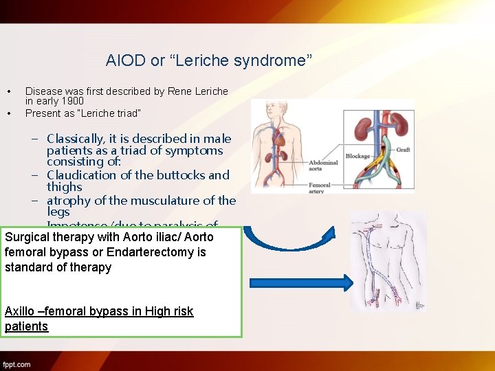 AIOD or “Leriche syndrome” • • Disease was first described by Rene Leriche in