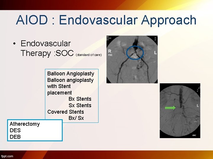 AIOD : Endovascular Approach • Endovascular Therapy : SOC (standard of care) Balloon Angioplasty