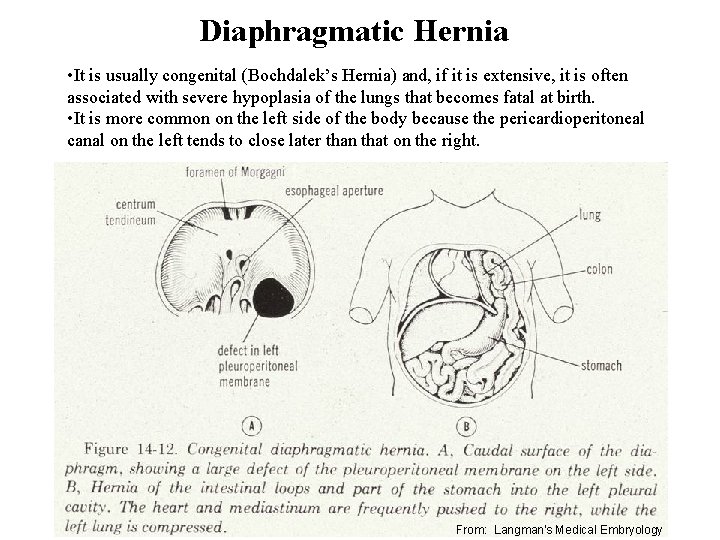 Diaphragmatic Hernia • It is usually congenital (Bochdalek’s Hernia) and, if it is extensive,