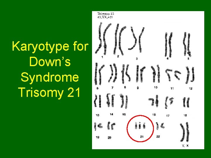 Karyotype for Down’s Syndrome Trisomy 21 