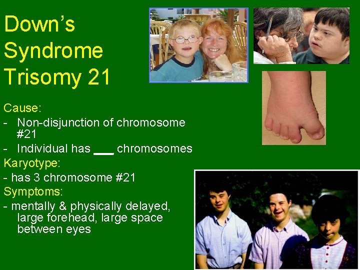 Down’s Syndrome Trisomy 21 Cause: - Non-disjunction of chromosome #21 - Individual has ___ Down’s Syndrome Trisomy 21 Cause: - Non-disjunction of chromosome #21 - Individual has ___