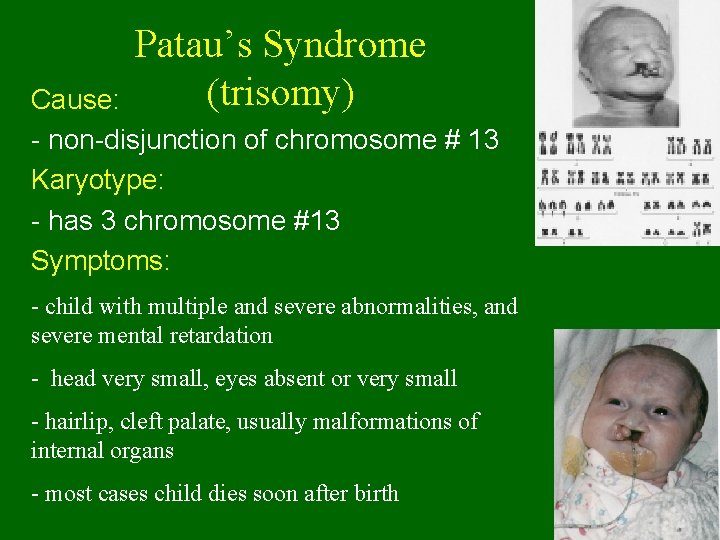 Patau’s Syndrome (trisomy) Cause: - non-disjunction of chromosome # 13 Karyotype: - has 3 Patau’s Syndrome (trisomy) Cause: - non-disjunction of chromosome # 13 Karyotype: - has 3