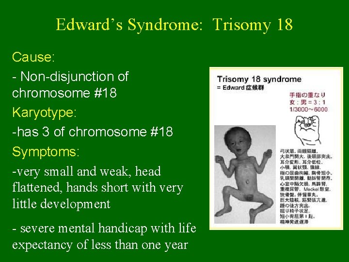 Edward’s Syndrome: Trisomy 18 Cause: - Non-disjunction of chromosome #18 Karyotype: -has 3 of