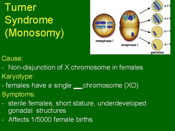 Turner Syndrome (Monosomy) Cause: - Non-disjunction of X chromosome in females Karyotype: - females